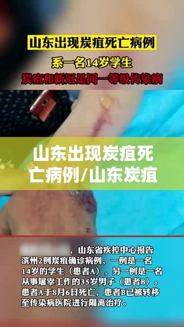 山东出现炭疽死亡病例/山东炭疽病毒事件