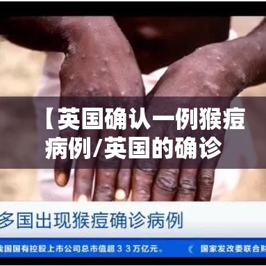 【英国确认一例猴痘病例/英国的确诊病例】