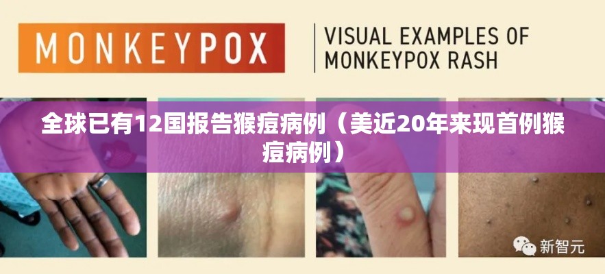 全球已有12国报告猴痘病例（美近20年来现首例猴痘病例）