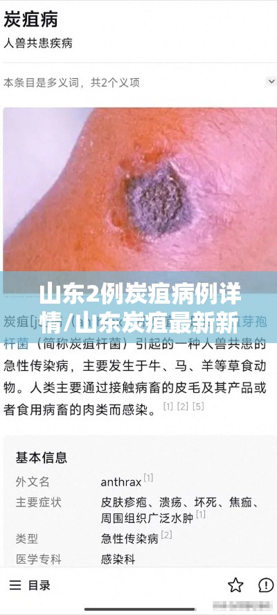 山东2例炭疽病例详情/山东炭疽最新新闻