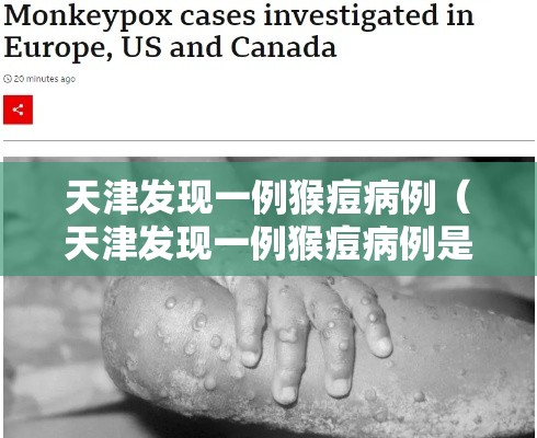 天津发现一例猴痘病例（天津发现一例猴痘病例是真的吗）