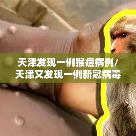 天津发现一例猴痘病例/天津又发现一例新冠病毒携带者