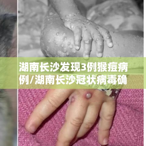 湖南长沙发现3例猴痘病例/湖南长沙冠状病毒确诊
