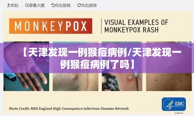 【天津发现一例猴痘病例/天津发现一例猴痘病例了吗】
