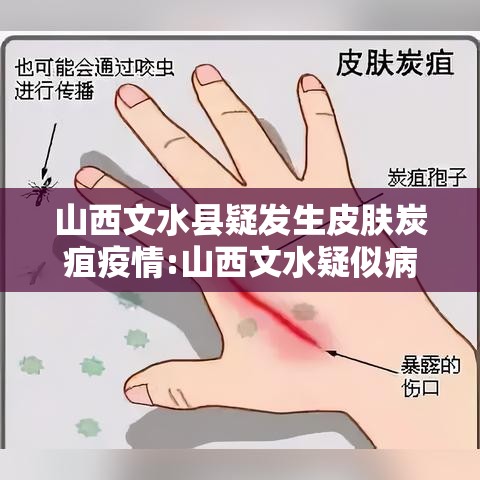 山西文水县疑发生皮肤炭疽疫情:山西文水疑似病例