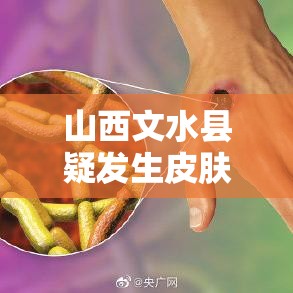 山西文水县疑发生皮肤炭疽疫情:山西文水疑似病例