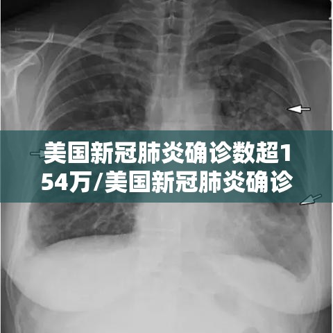 美国新冠肺炎确诊数超154万/美国新冠肺炎确诊超507万例